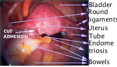 Adhsions due to endometriosis