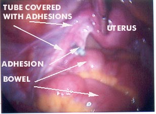 Adhsions female pelvis