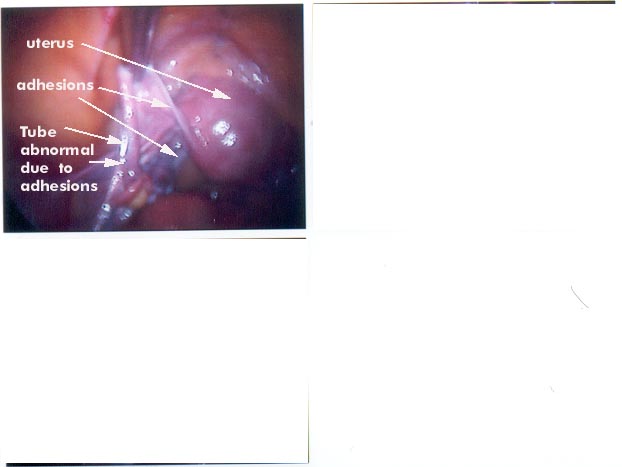 Adhsions woman  pelvis